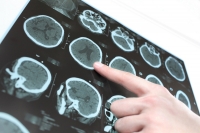 ¿Cómo reacciona el cerebro de un enfermo de fibromialgia?